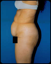 Abdominoplasty - Tummy Tuck 
