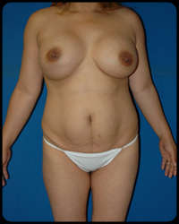 Abdominoplasty - Tummy Tuck 