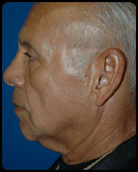Face and Neck Surgery 