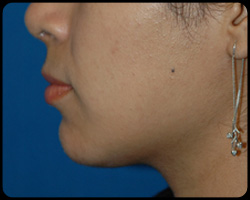 Chin Surgery - Genioplasty 