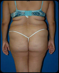 Liposuction and Body Contouring - Suction Assisted Lipectomy (SAL) 