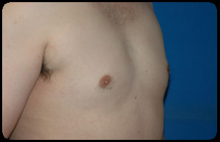 Liposuction and Body Contouring - Suction Assisted Lipectomy (SAL) 