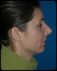 Nasal Surgery - Rhinoplasty 