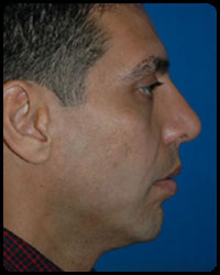 Nasal Surgery - Rhinoplasty 